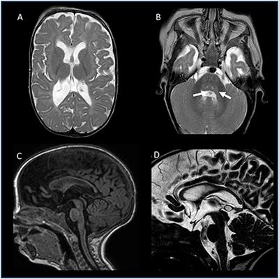 Neuromuscular and Neuroendocrinological Features Associated With ZC4H2-Related Arthrogryposis Multiplex Congenita in a Sicilian Family: A Case Report